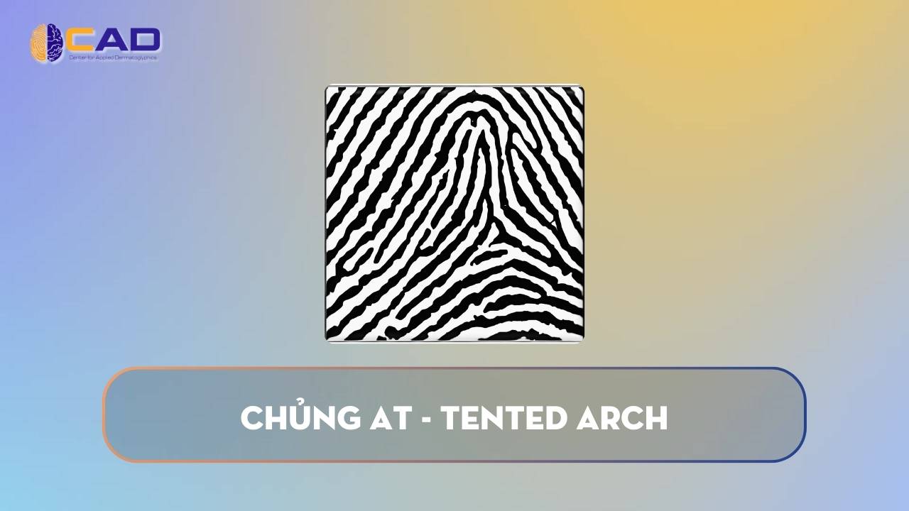 Chủng AT - Tented Arch