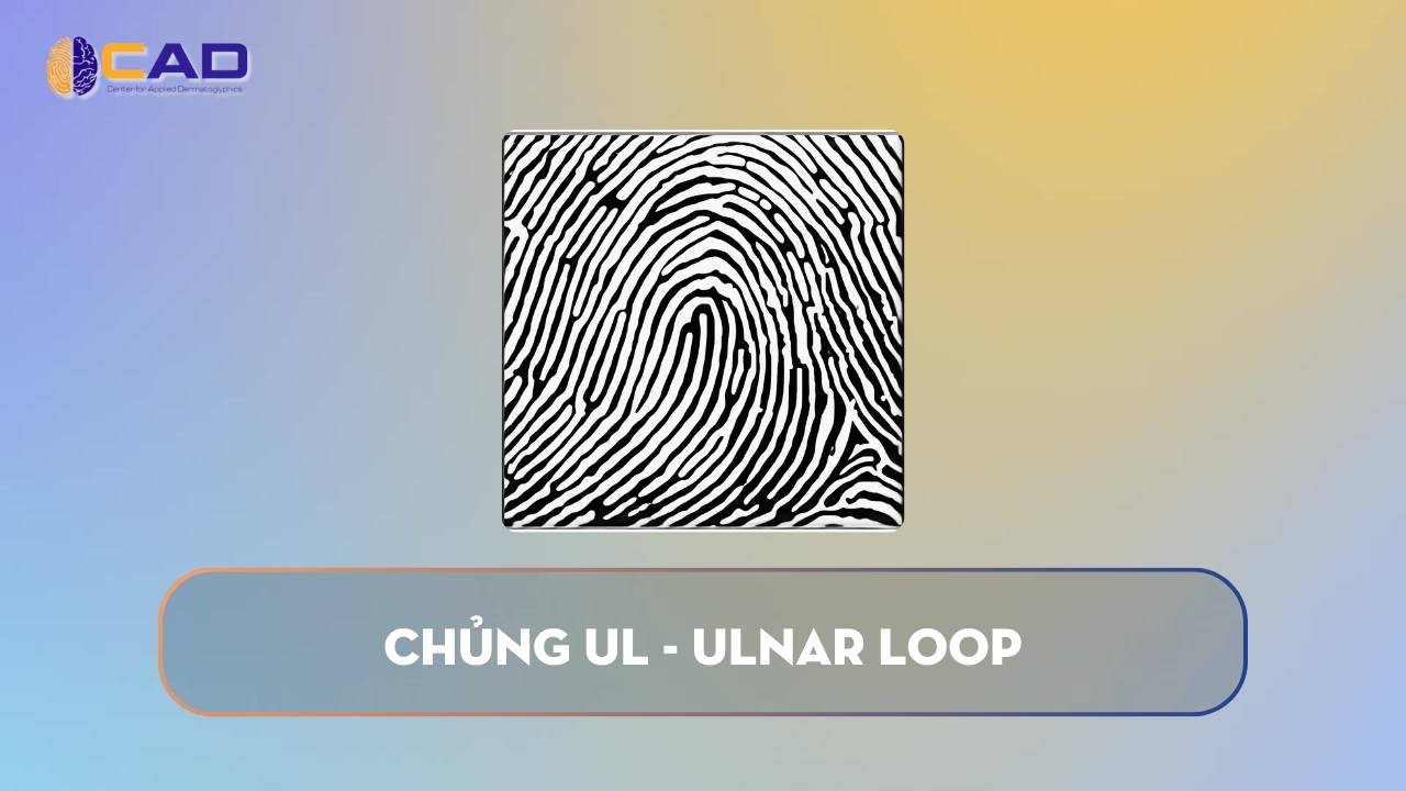 Chủng UL - Ulnar Loop