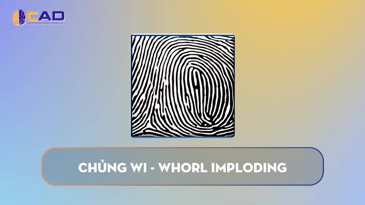Chủng WI - Whorl Imploding