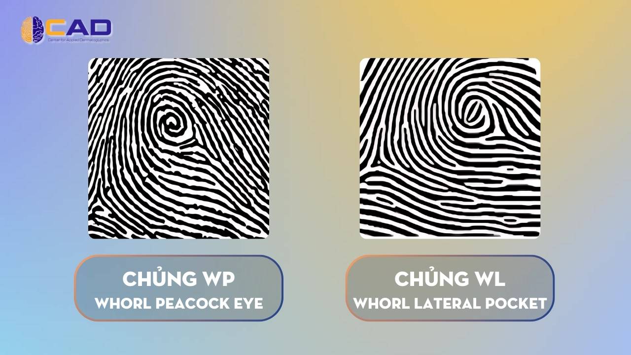 Chủng WP & chủng WL - Whorl Peacock Eye - Whorl Lateral Pocket