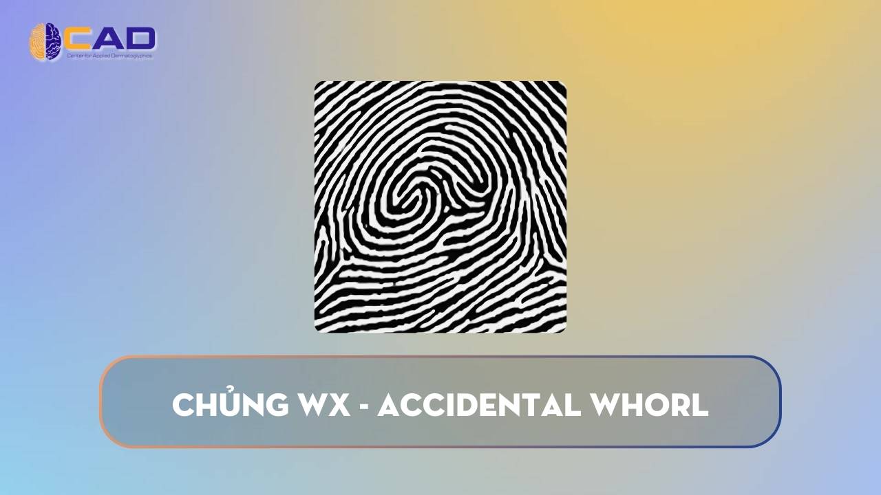 Chủng WX - Accidental Whorl